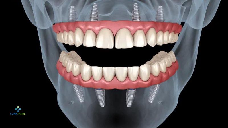 All on 6 Dental Implants Istanbul