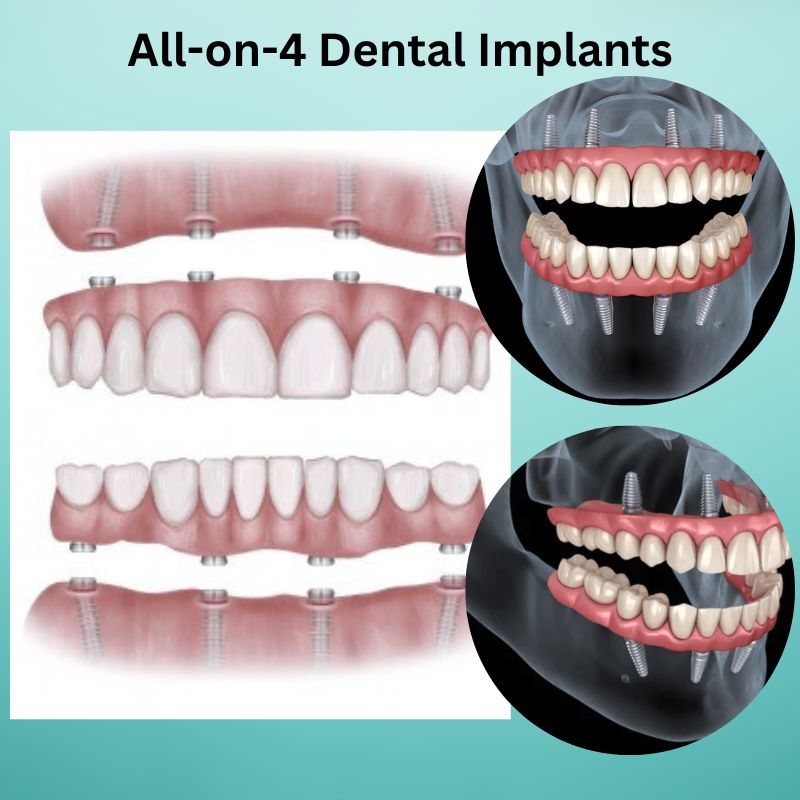 what is all on 4 dental implants