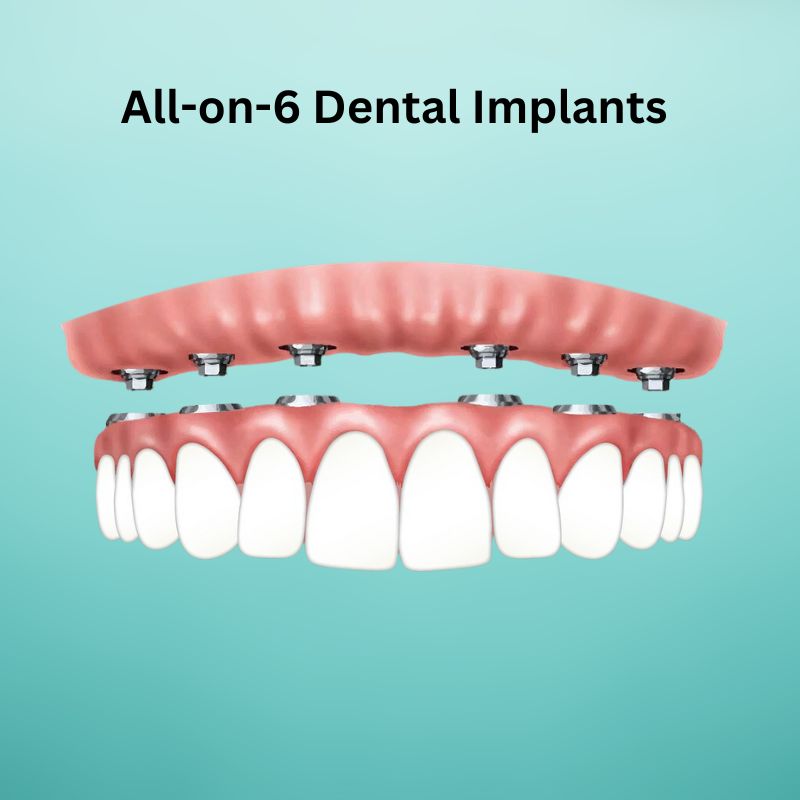 what-is-all-on-6-dental-implants