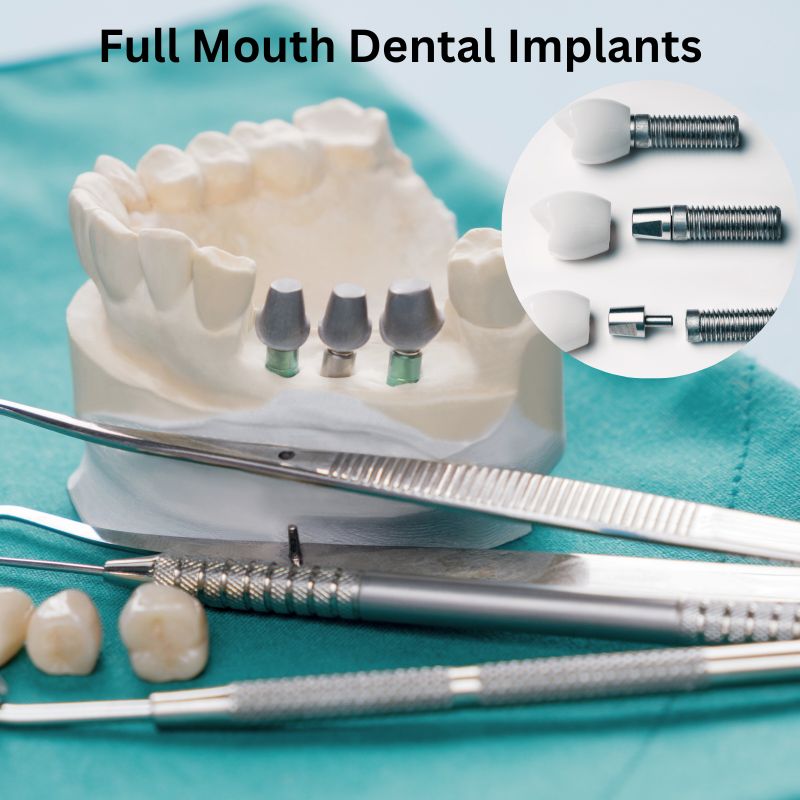 full-mouth-dental-implants