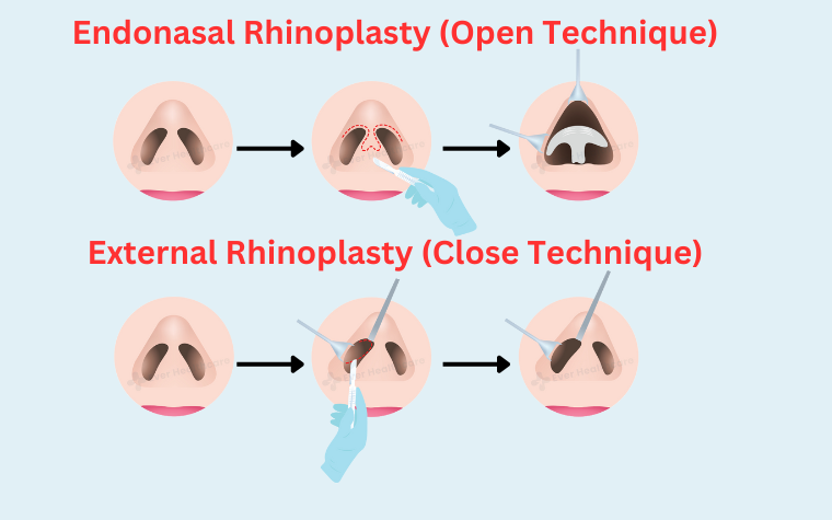 rhinoplasty technique Turkey