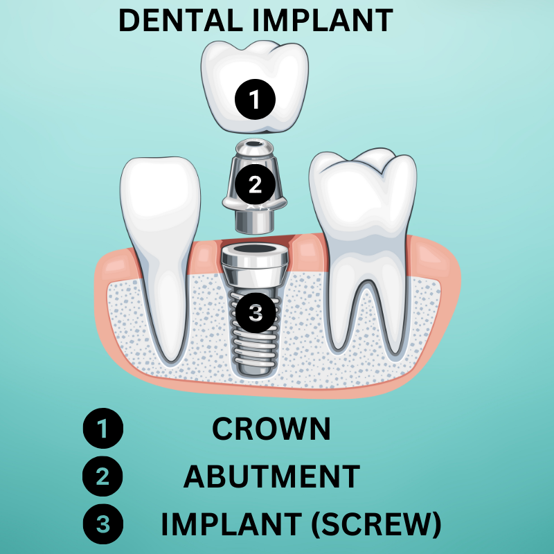 what-is-dental-implant